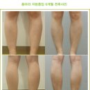 => [전후사진] 종아리 지방흡입 6개월 후 이미지