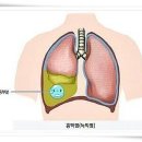 늑막염의 증상과 치료 이미지