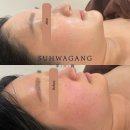 향원장 | 송파피부관리 홍조피부 도대체 어떻게 해야 할까?