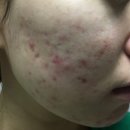 마주본한의원 | 여드름전문한의원 염증 색소침착 원인 치료 후기
