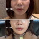 필업 | 압구정 성형외과 팔자주름 시술 필업 콜라겐 주사 후기