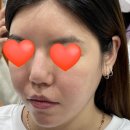 예지인피부과의원 | 피코프락셀레이저가격 무릎,팔꿈치,겨드랑이색소침착레이저토닝이벵트