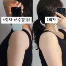 서울대학교직장부속의원 | 대구 비만클리닉의원 대망의 하프컷 팔뚝지방분해주사 4회차 후기