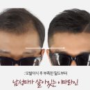 대구 남자헤어라인 선택 , 후기 좋은 곳은 어디?