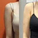 팔뚝무한람스 3달차 기록, 지방추출주사 흉은 많이 졌을까요?