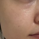 톤즈의원 인천부평본점 내돈내산 기미레이저 효과 솔직리뷰 추천