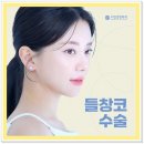 들창코 | 들창코 수술 후기 통해 보는 변화 과정