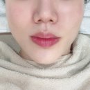 의정부피부관리 예오미오 잡티관리 색소레이저 후기