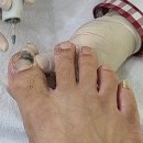 러닝 후 내성발톱·새끼발가락 변형 케어 | 당산 풋스올