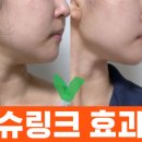 서울 피부과 추천 7곳 ! 대표 후기 시술 비용 정보(여드름, 잡티, 리프팅, 슈링크)