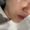 강남 피부과 피부탄력 개선을 위한 울쎄라 후기 (고통, 시술시간 등)