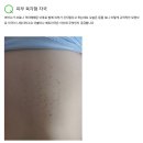 백신 접종자들 피부에 '육각 모양'의 발진이 나타나고 있다/ 접종자 피부 마크는 5G 무선 안테나? 이미지