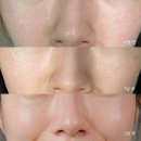 코차코퍼레이션(주) | 장나라 풀텐자 모공디바이스 화이트헤드 관리 2달 차 후기
