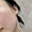레드튠 | 강남역 피부과: 튠페이스, 튠블루+튠레드 후기