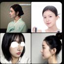 오층조은약국 | 코 단차 매부리코 코재수술 당일,2일차 후기 feat.기증진피,솜제거