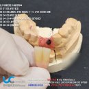 성원장 | 길음역치과 추천 노인임플란트 수량은?