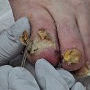 효성케어 | 조갑구만증 어르신 문제성 발톱 통증 없는 케어 후기