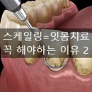 콩세알튼튼치과의원 | [치과 지식사전] 잇몸 염증 치료 스켈링(스케일링) 총정리 2