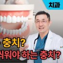 때워도 되는 충치와 크라운으로 씌워야 하는 충치 / 선릉뉴연세치과 류성용/의학채널비온뒤 이미지