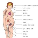 스테로이드 고용량으로 오래 먹을 때 몸 붓는건 소식해도 해결 못하오? 이미지