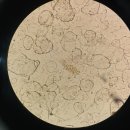 urine wbc cast일까요? 그냥 뭉친걸까요? 이미지