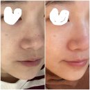 YJskincare | 울산남구피부관리 유진스킨케어 모공+블랙헤드 컴플렉스 극복