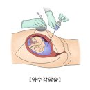 양수과다증Hydramnios여성질환 이미지