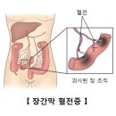 장간막 동맥 혈전증[Mesenteric Arterial Thrombosis] 이미지