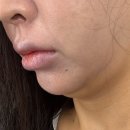 평택온다리프팅,효과짱리얼후기!!(이중턱/심부볼) 라인정리하기!!