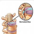 Muscle&Spine(머슬앤스파인) 경추디스크★ 이미지