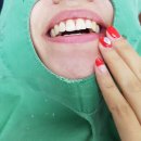 누렁니 탈출~! 치과 치아미백전후 후기(가격, 통증,효과,부작용?) ⓦ.에투알드서울치과