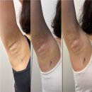 작은땀 | 겨드랑이 땀 때문에 고민하다 선택한 미라드라이 시술 당일 솔직 후기