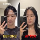 이수역 | 이수역 피부과 티타늄 리프팅 솔직 후기 | 생애 첫 리프팅 결과!