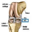 십자인대파열, 치료법 이미지