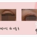 MK성형외과 네이버블로그