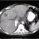 문맥색전증(Portal vein thrombosis) 이미지