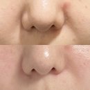미희네 | 강남피부과 볼륨부스터 미희주사 후기 | 팔자주름 눈밑꺼짐 볼패임 좌우 비대칭 고민이라면