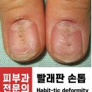 (주)코리아세븐 서울대제일점 | 손톱, 물어뜯지 마세요. (Habit-tic nail deformity)
