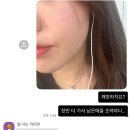 대신한의원 | 강남 편평사마귀 치료 레이저 치료 대신 선택한 피부한의원 대만족 내돈내산 후기♡