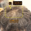 여자 링거펌 망한사례 대구 아이롱펌으로 복구한 층이 많은 곱슬머리 후기