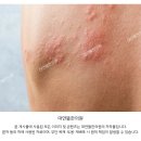 천수한의원 | [치료후기] 대상포진 1년 후에도 남은 신경통 치료 (81세,남)