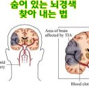 숨어있는 뇌경색 찿아내는법 이미지