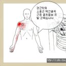 골프엘보 소흉근 풀자 ~~~~ 이미지