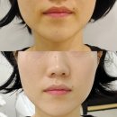 한국메디칼 대구지사 | 대구리프팅 프라셀맥스를 통한 모공축소관리 콜드플라즈마지사 아미뷰티