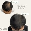 익산희망요양병원 | 익산탈모병원 치료 효과 후기 솔직하게 말합니다