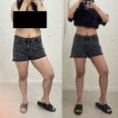 (주)브라보주유소 | 허벅지지방추출주사후기 - 천안 허벅지살빼기(6)