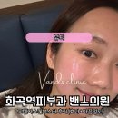 화곡피부과 모공축소에좋은 포텐자 스킨부스터 쥬베룩 후기 +추천이유