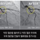 버거씨병(혈관염) 줄기세포치료 이미지