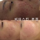 비아스킨