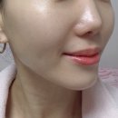 여의도 피부과 쥬베룩 볼륨 시술 내돈내산 리얼 후기